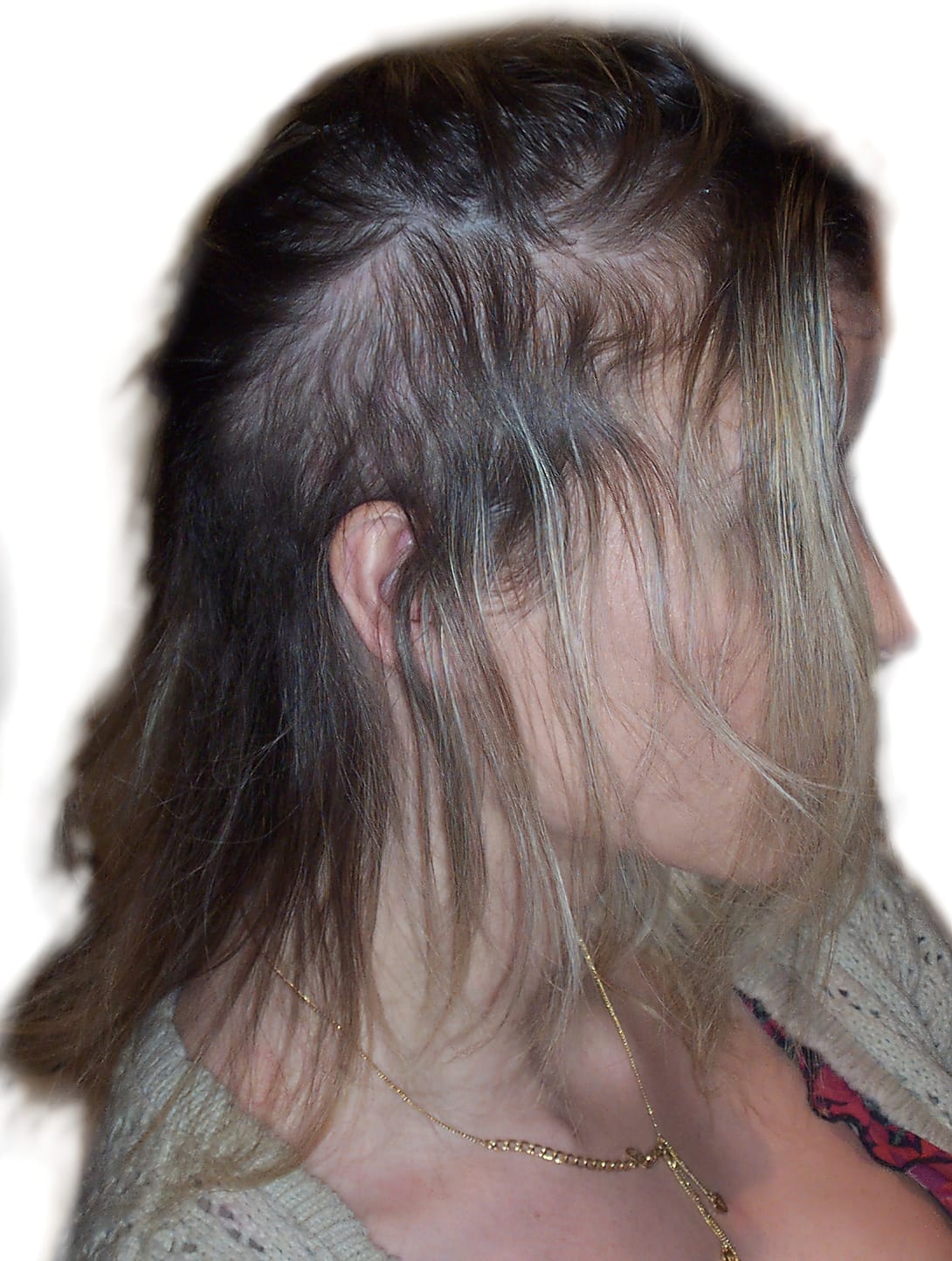 Before Picture - Traction Alopecia Caused By Human Hair Extensions